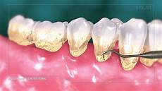 Dental Tools
